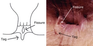 Пункционный и клизменный метод лечения хронической трещины заднего прохода.