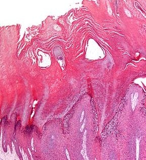 Удалить вирусные бородавки всеми способами.