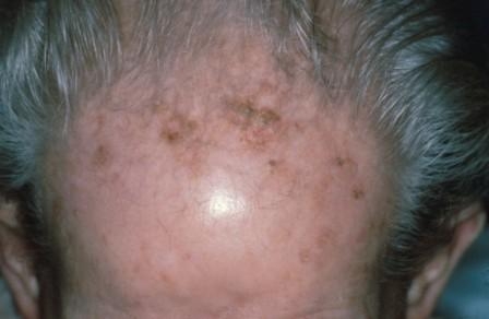 Кератоз кожи. Актинический кератоз.