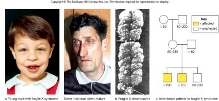 Синдром ломкой или фрагментированной Х хромосомы