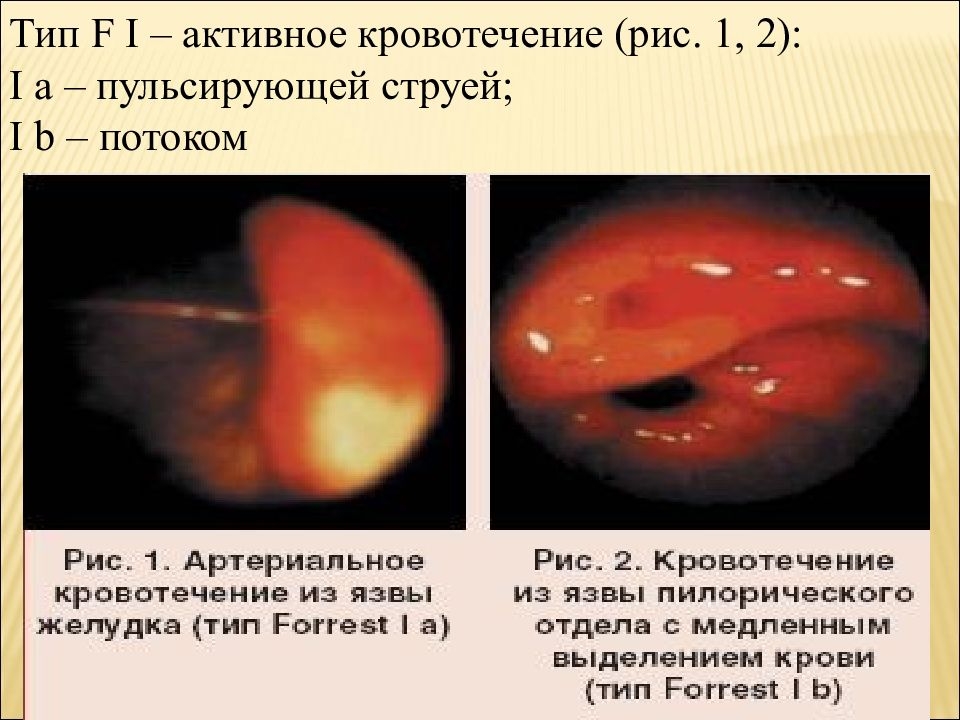 Симптомы язвы желудка и двенадцатиперстной кишки. Тактика лечения при Кровотечении из язвы.