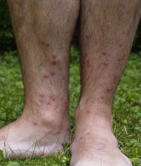 Церкариоз, кожный паразит.