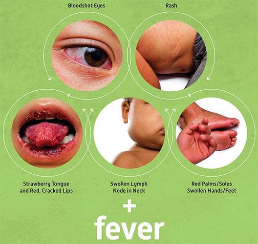 Болезнь или синдром Кавасаки. Вести из Азии.