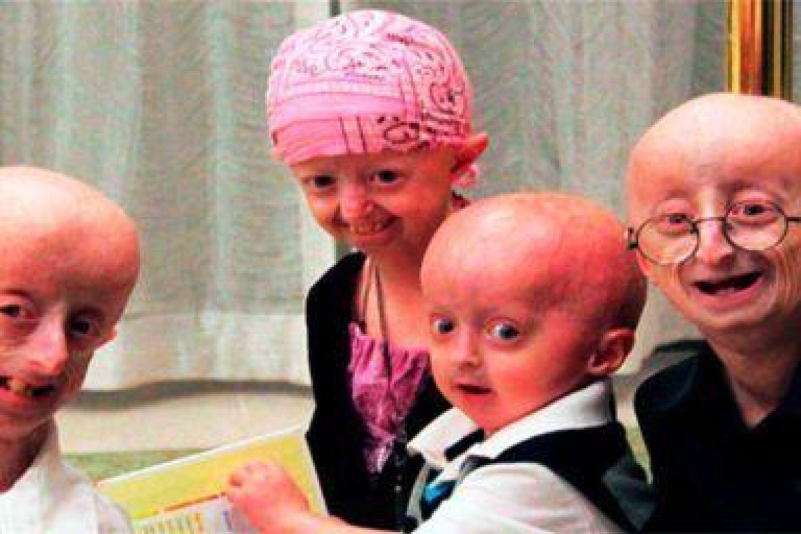 Синдром Хатчинсона-Гилфорда