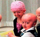 Синдром Хатчинсона-Гилфорда