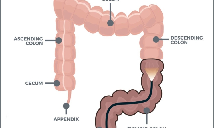Как подготовиться к колоноскопии ?(способы подготовки).