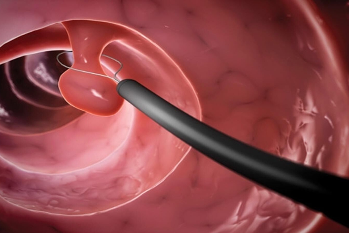 Что такое колоноскопия? Какой препарат использовать при подготовке для удаления полипа.