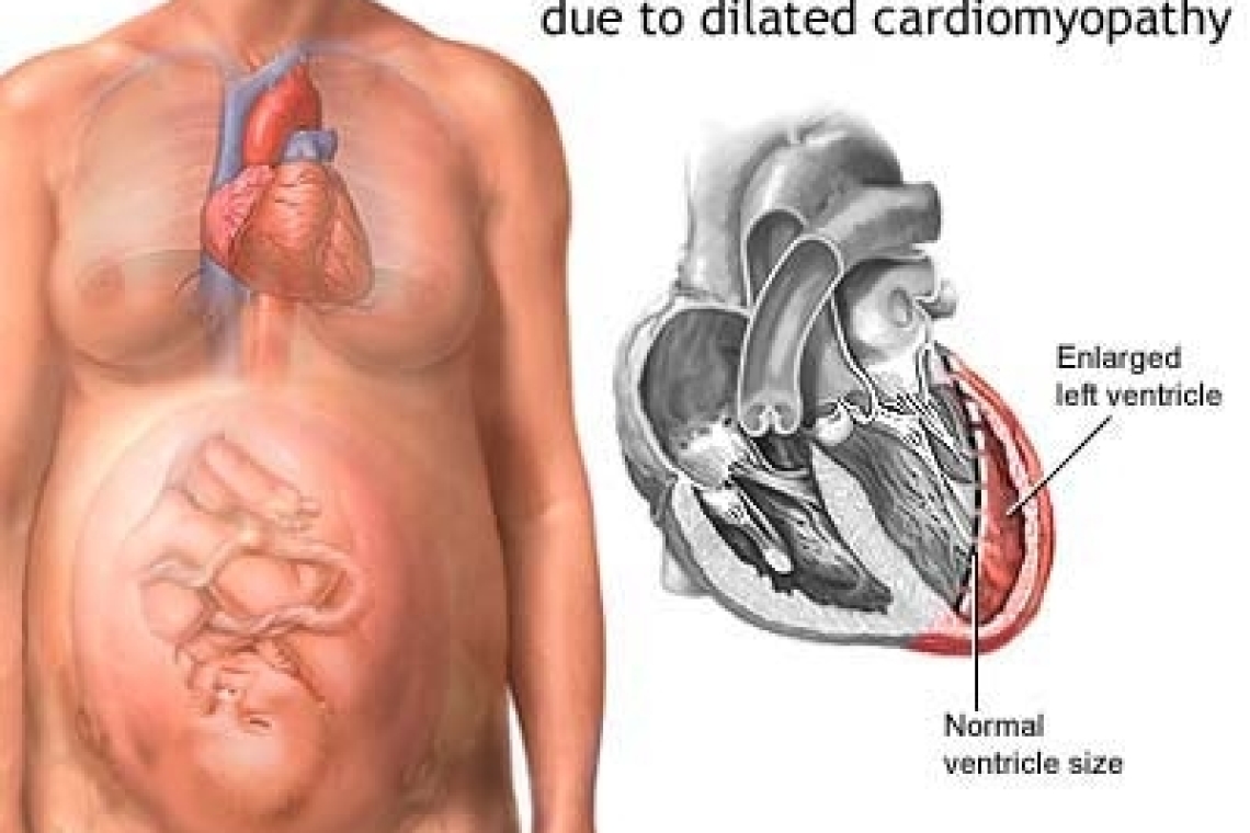 Гипертрофическая кардиомиопатия. Как выносить ребенка.