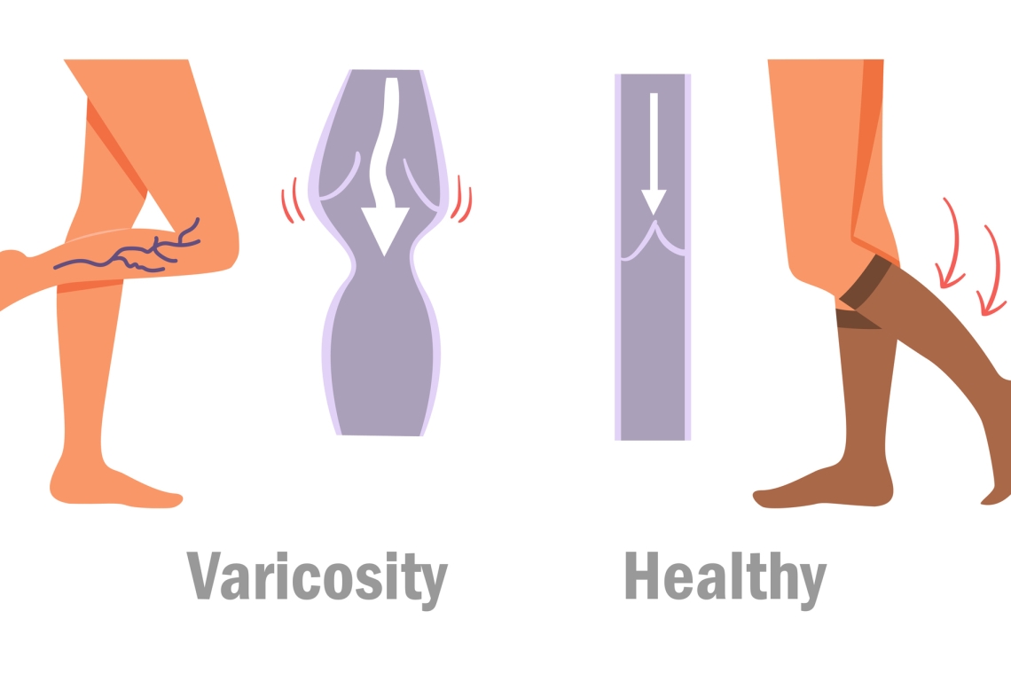 Классификация. Компрессионный трикотаж