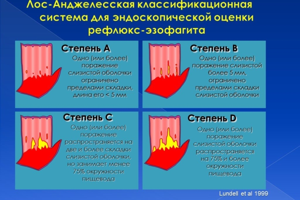 Лосанджелесская классификация Рефлюкс-Эзофагита 1994 г.