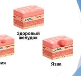 Язвы и эрозии. Что такое гемосидерин, гематин, и почему врач-эндоскопист ошибается.