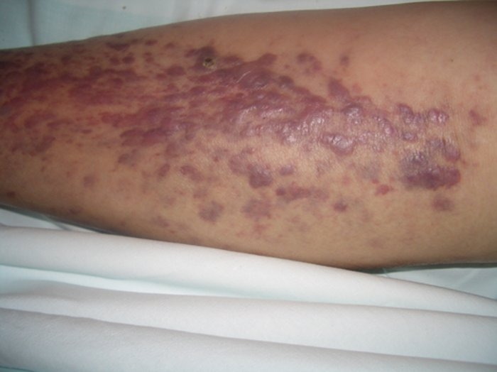 Что такое саркома Капоши?