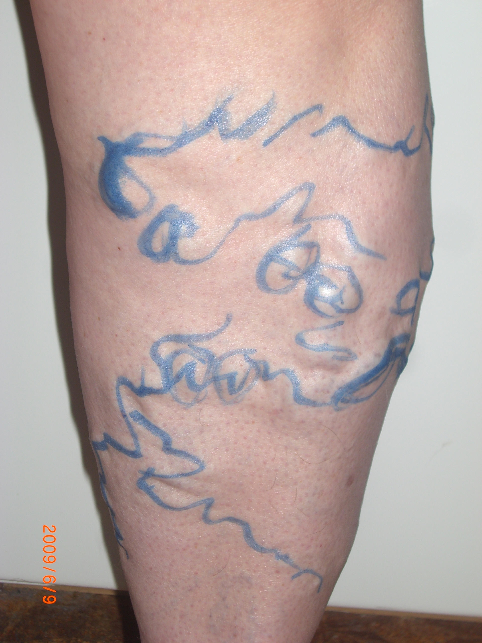 Тактика лечения варикозной болезни