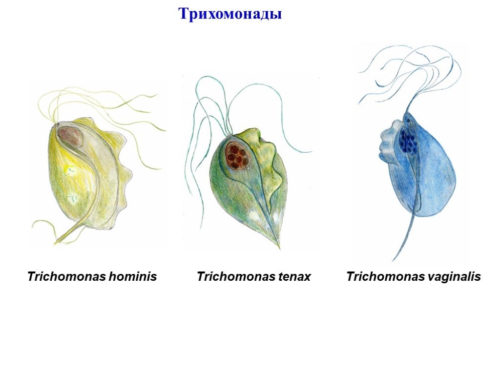 Трихомоноз или трихомониаз. Возбудитель половой инфекции - трихомонада.