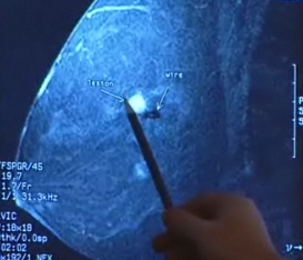 Вы нашли уплотнение в груди. Рак?