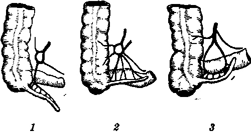 Острый аппендицит. После операции: как себя вести, что кушать и как ухаживать за швами.