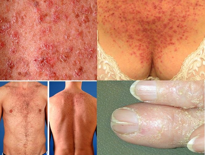 Фолликулярный кератоз. Болезнь Дарье, причина, лечение, фото. (дискератоз фолликулярный)