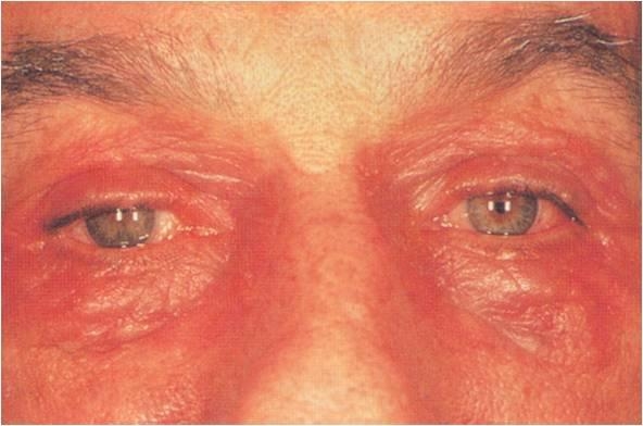 Аллергический дерматит и диффузный нейродермит. Симптомы. Лечение. Профилактика обострений.