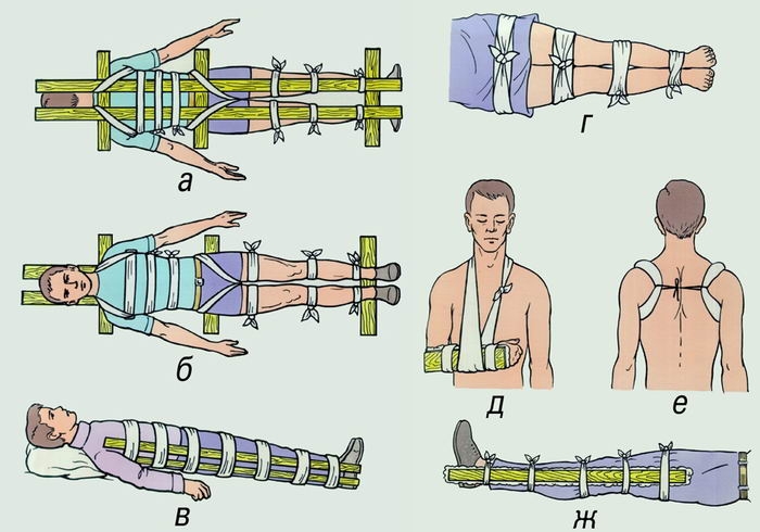 Транспортная иммобилизация