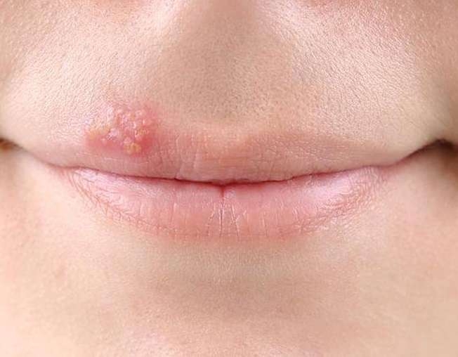 Вирус герпеса