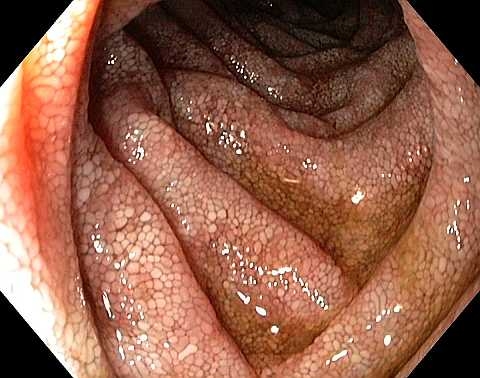 Что такое болезнь Уиппла? Так ли безобиден понос.