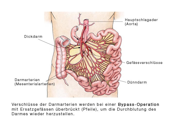 Хронические нарушения висцерального кровообращения.