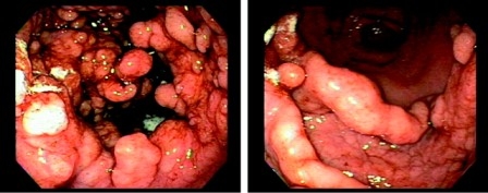 Редкая патология. Гигантский гиперпластический гастрит. Болезнь Менетрие.