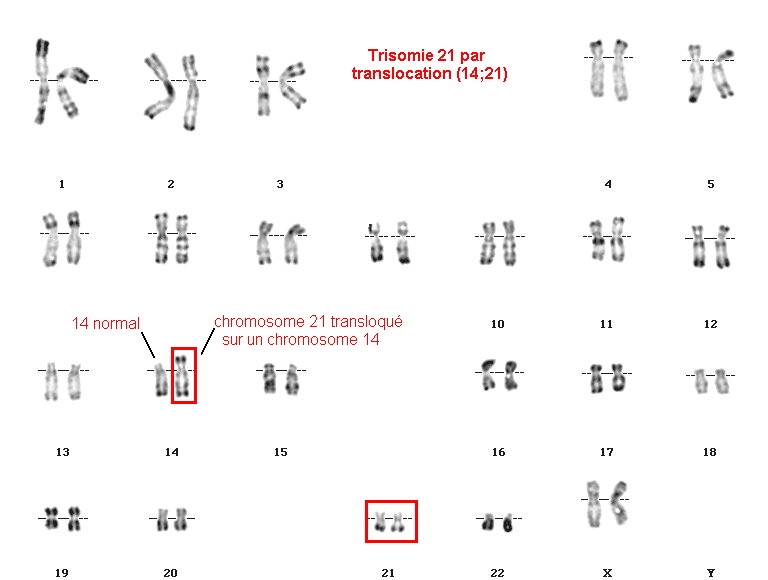 Синдром Дауна. Дети с синдромом Дауна. Признаки и причины.