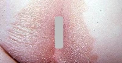 Анальный зуд, кожная аллергия?