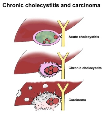 Рак желчного пузыря, полипы и доброкачественные опухоли.