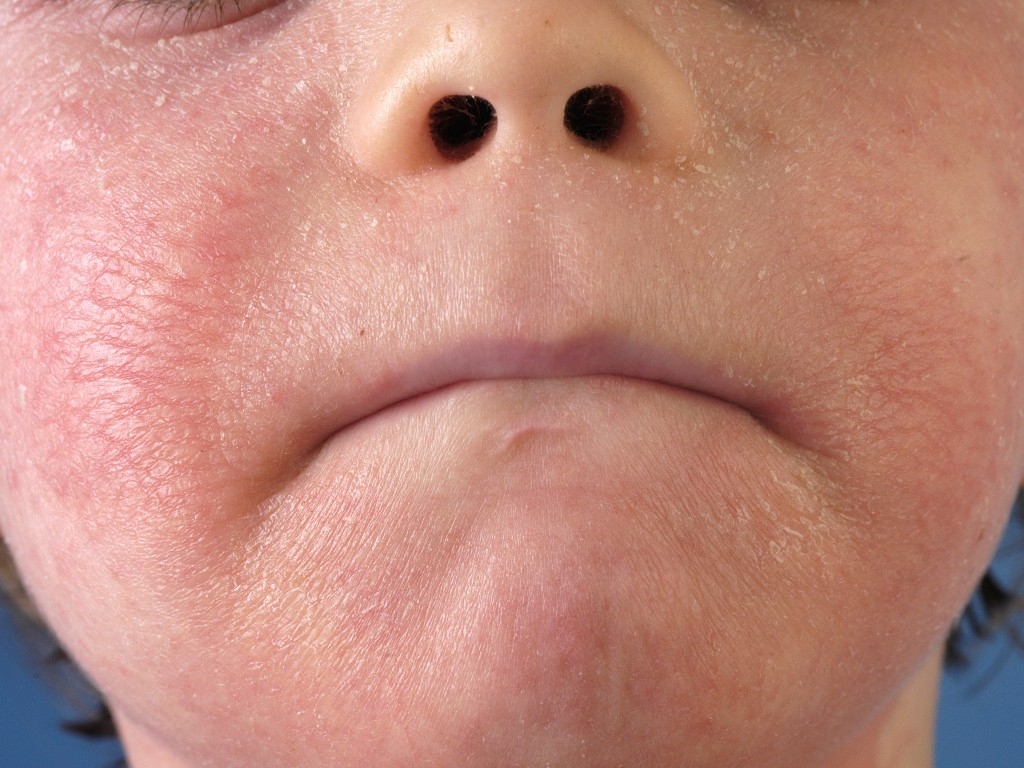 Атопический дерматит. Болезни кожи. Атопическая экзема.