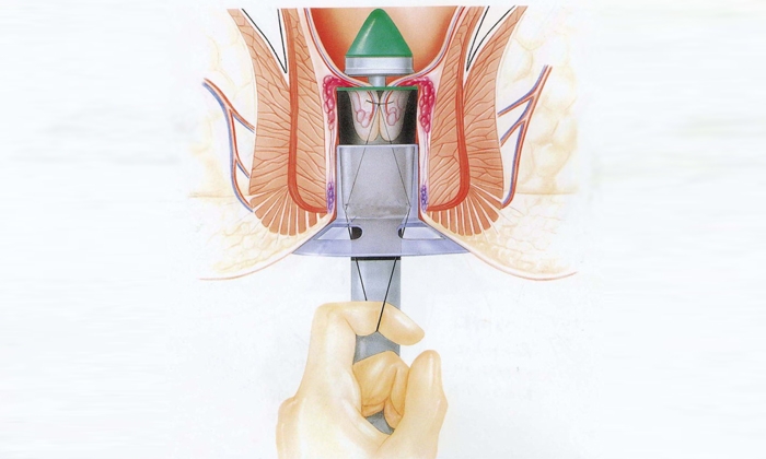 Геморрой, лечение без операции, реабилитация после операции.