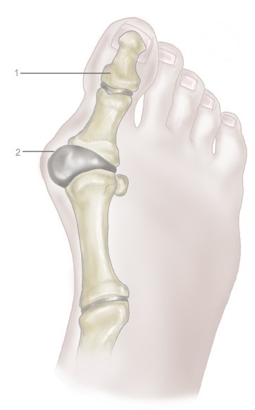 Бурсит большого пальца стопы. Болит косточка на ноге.