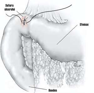 Язва. Осложнения язвенной болезни желудка и 12 перстной кишки. Перфорация, перитонит, тактика и лечение.