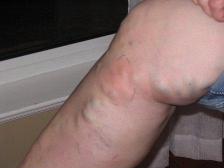 Тактика лечения тромбофлебита и флеботромбоза нижних конечностей.